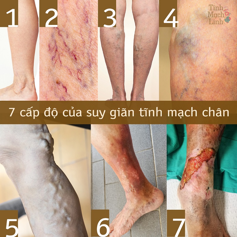 Suy giãn tĩnh mạch chân chẩn đoán và cách điều trị Đông Y 