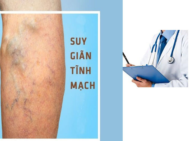 3 việc bạn nhất định cần ghi nhớ khi bị suy giãn tĩnh mạch