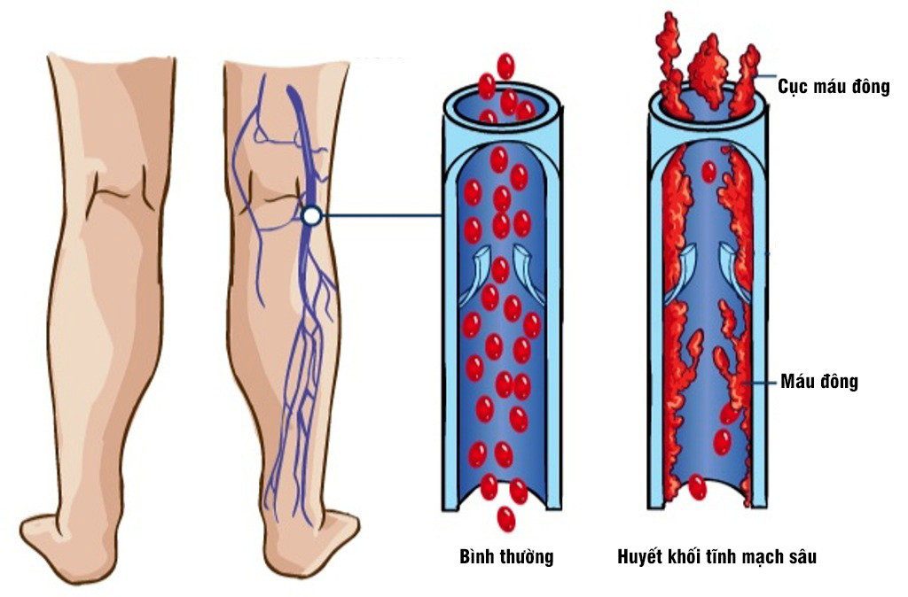 Những nguy cơ và biến chứng khi viêm tắc mạch máu 