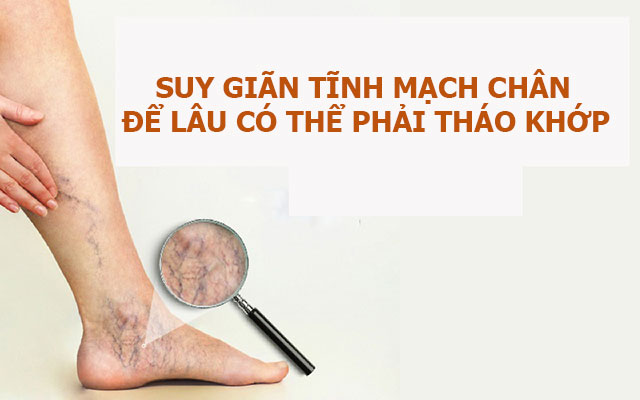 Bệnh suy giãn tĩnh mạch chân để lâu có thể phải tháo khớp