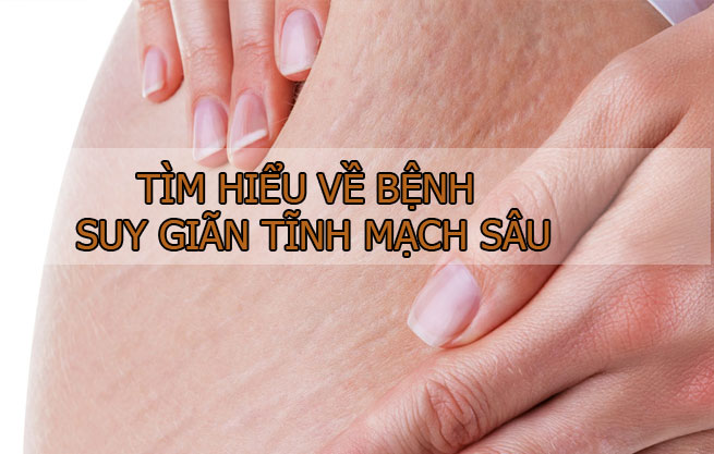 Suy giãn tĩnh mạch sâu là gì, nguy hiểm như thế nào tới sức khoẻ và đôi chân của người bệnh