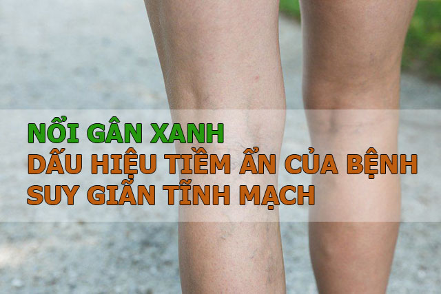 Các triệu chứng điển hình của suy giãn tĩnh mạch như dấu hiệu nổi gân xanh